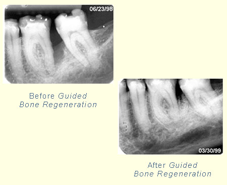 Bone Grafting Case Study