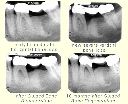 Bone Grafting Case Study