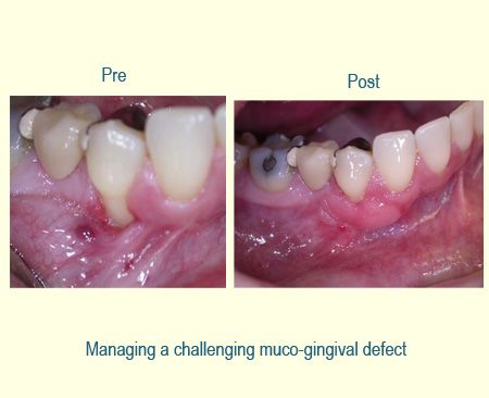 Gingival Grafting Case Study